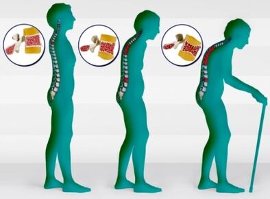 οστεοπόρωση